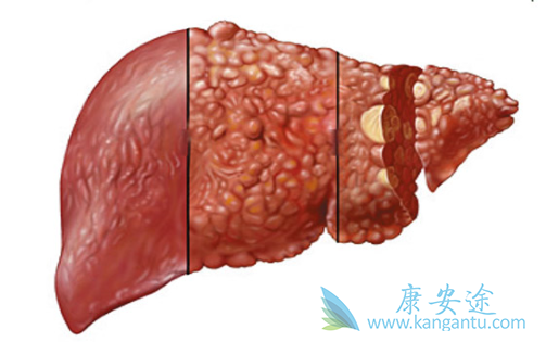 肝癌能治好吗 肝癌能治好吗