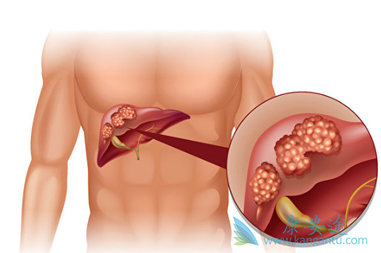肝癌晚期治疗 肝癌晚期治疗
