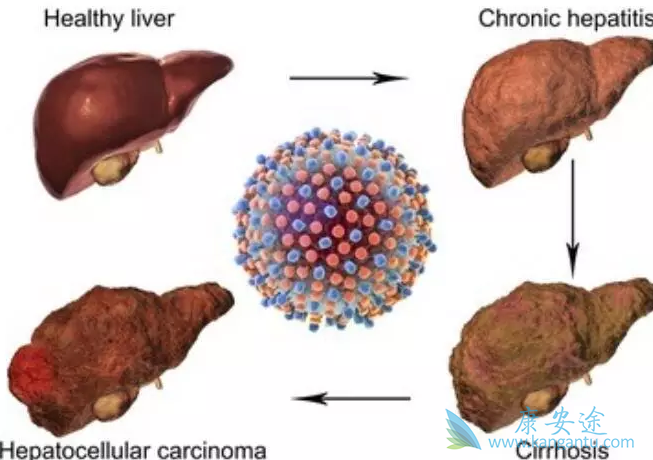 丙肝的危害 丙肝的危害