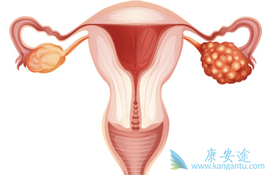 卵巢癌的治疗 卵巢癌的治疗