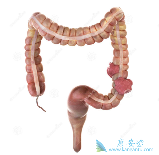 结肠癌治疗 结肠癌治疗