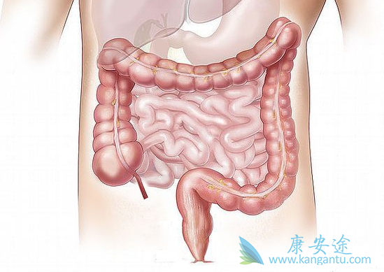 结肠癌的症状 结肠癌的症状