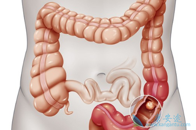 结直肠癌 结直肠癌