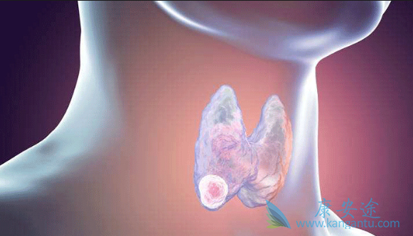 甲状腺肿瘤症状 甲状腺肿瘤症状