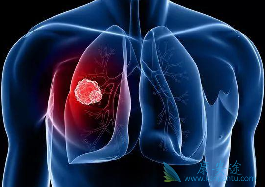 肺癌复发症状 肺癌复发症状