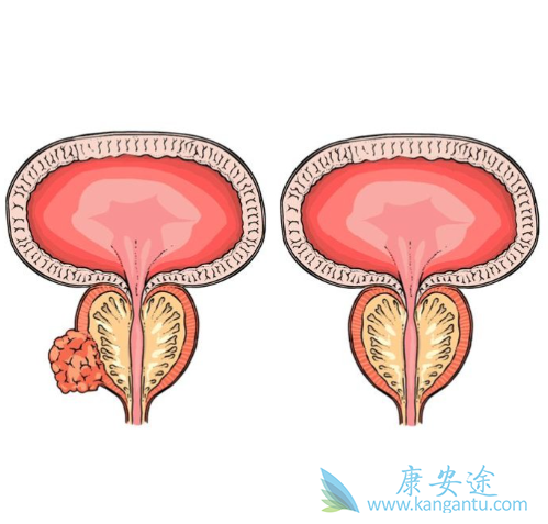 前列腺癌症状 前列腺癌症状