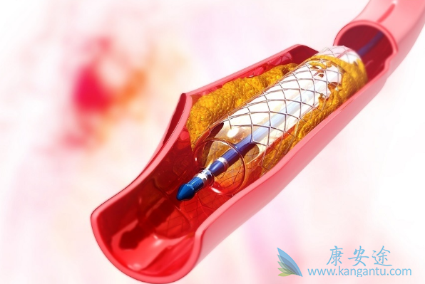 心脏支架手术后寿命 心脏支架手术后寿命