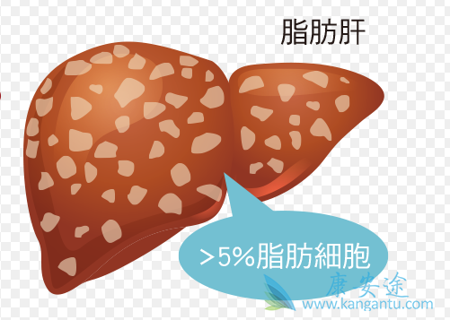 非酒精性脂肪肝病 非酒精性脂肪肝病