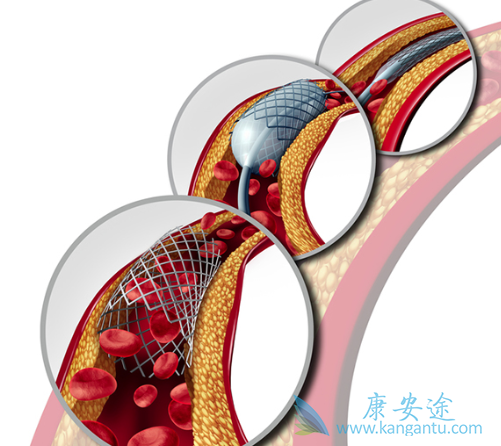 心脏支架手术后寿命 心脏支架手术后寿命
