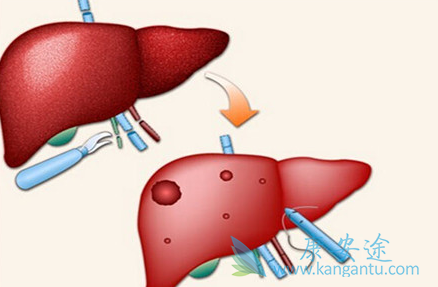 丙肝传染方式 丙肝传染方式