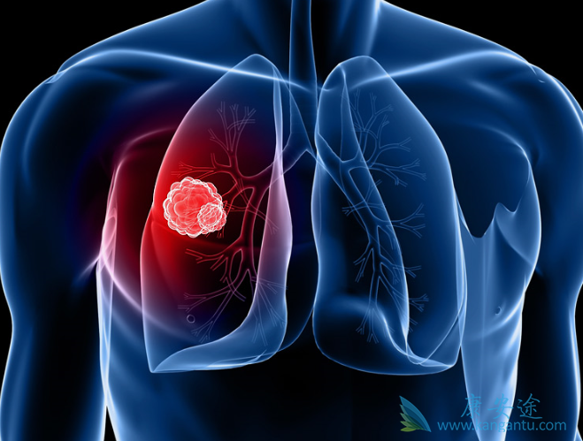 小细胞肺癌生存期 小细胞肺癌生存期