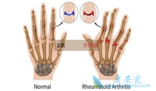 类风湿新药 类风湿新药