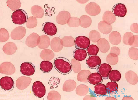 慢性淋巴细胞白血病 慢性淋巴细胞白血病