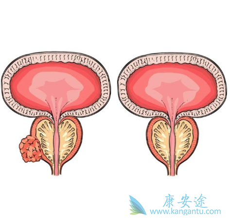 转移性前列腺癌 转移性前列腺癌
