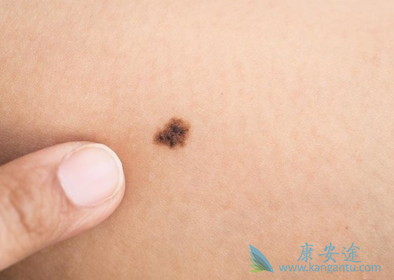 黑色素瘤早期症状 黑色素瘤早期症状