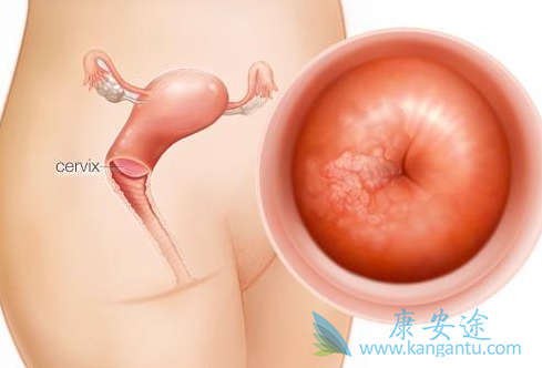 宫颈癌 宫颈癌