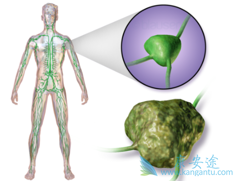 淋巴癌晚期 淋巴癌晚期