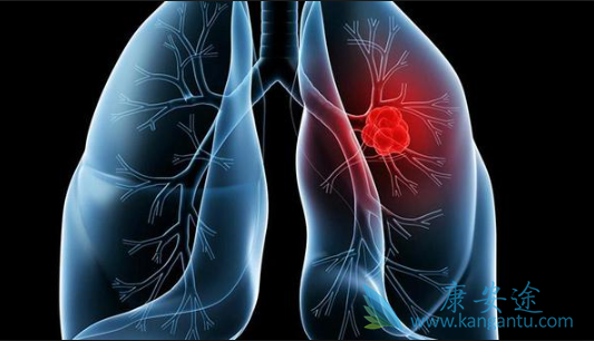 肺鳞癌 肺鳞癌