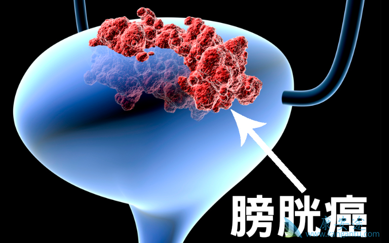 膀胱癌症状 膀胱癌症状