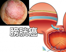ת���԰��װ���atezolizumab����Ч����ô����