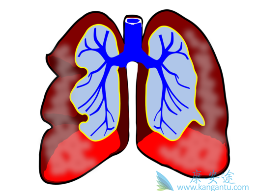 肺动脉高压 肺动脉高压