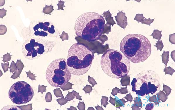 骨髓增生异常综合症 骨髓增生异常综合症