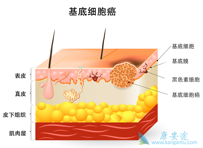 基底细胞癌 基底细胞癌
