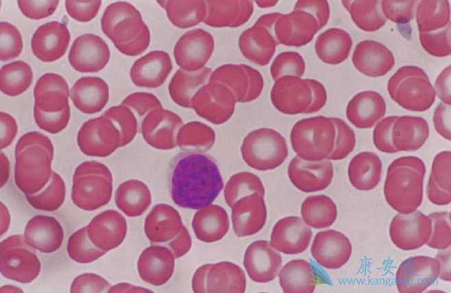 慢性淋巴细胞白血病 慢性淋巴细胞白血病