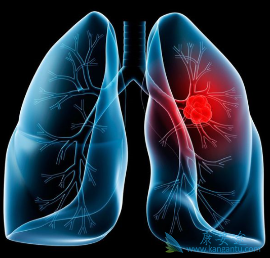 肺癌晚期的症状 肺癌晚期的症状
