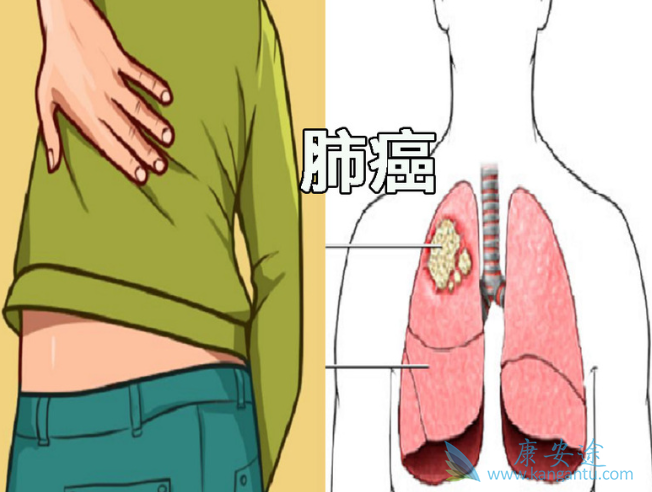 肺癌晚期症状 肺癌晚期症状