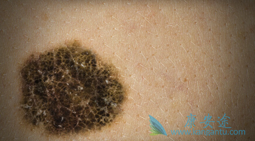 黑色素癌 黑色素癌