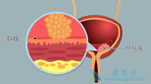 膀胱癌症状 膀胱癌症状