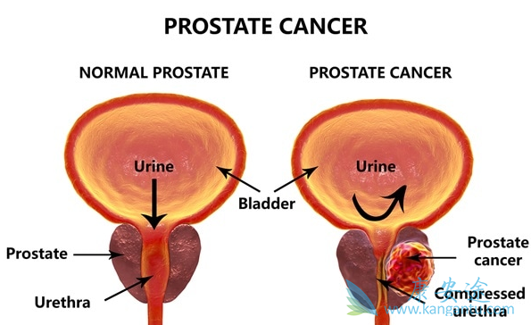前列腺癌分期 前列腺癌分期