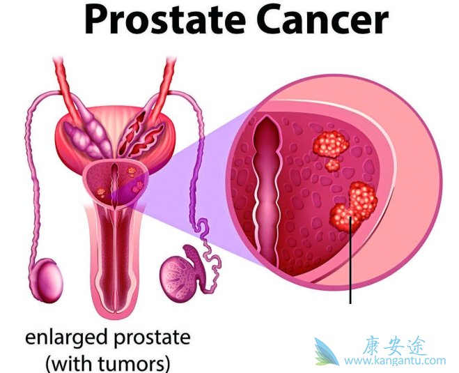前列腺癌能活多久 前列腺癌能活多久