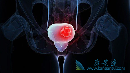 膀胱癌晚期症状 膀胱癌晚期症状