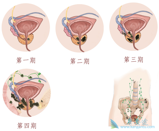 前列腺癌分期 前列腺癌分期