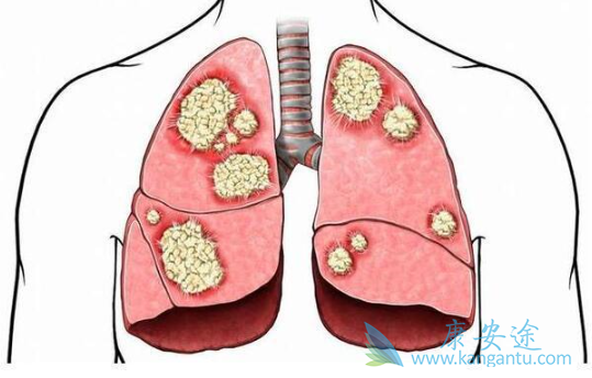 肺癌腺癌 肺癌腺癌