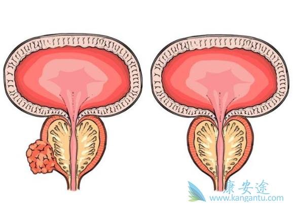 前列腺癌 前列腺癌