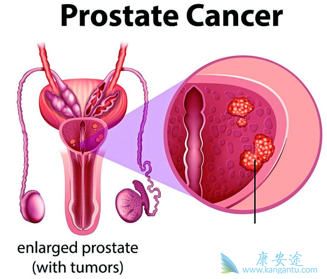 前列腺癌 前列腺癌