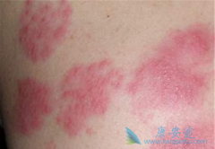 ʹ�÷��Ӱ���ҩ��������Ƥ����ô���ƣ�