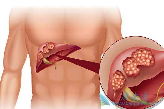肝癌晚期有什么症状 肝癌晚期有什么症状