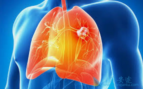 肺癌能治好吗 肺癌能治好吗