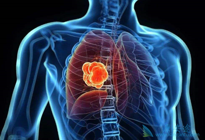 肺癌脑转移 肺癌脑转移