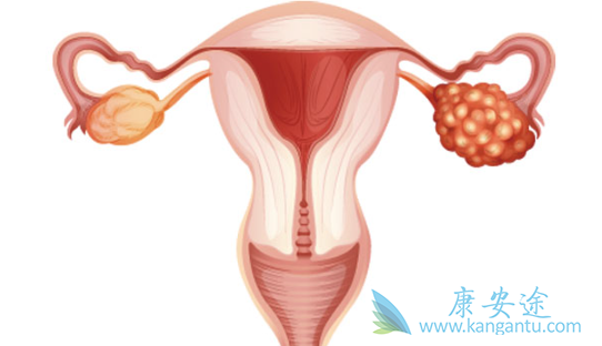 卵巢癌治疗 卵巢癌治疗