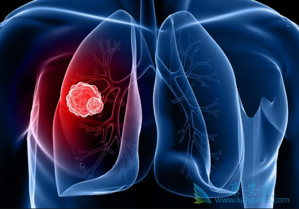 肺癌能治好吗 肺癌能治好吗