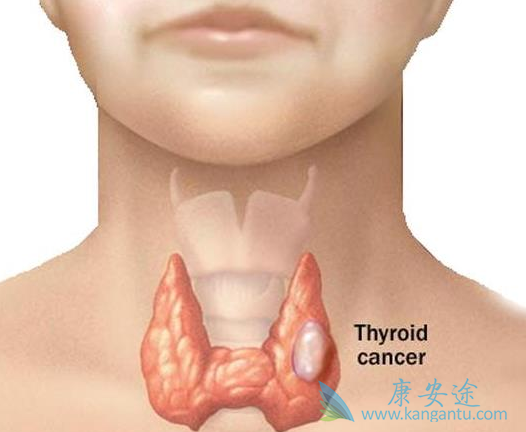 甲状腺癌 甲状腺癌