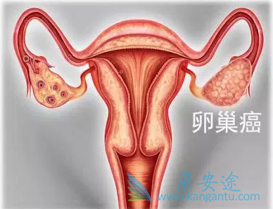 卵巢癌 卵巢癌