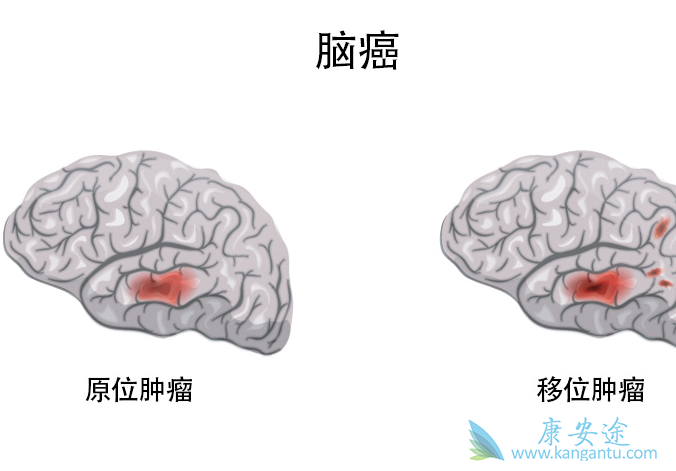 脑部肿瘤 脑部肿瘤