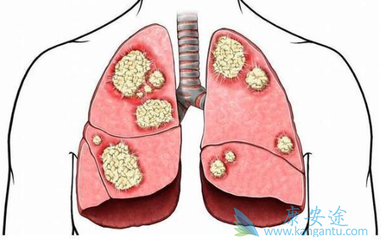 肺癌腺癌 肺癌腺癌