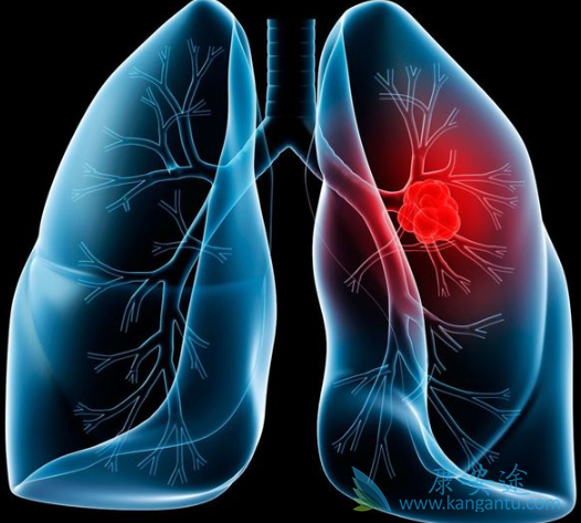 肺癌脑转移症状 肺癌脑转移症状